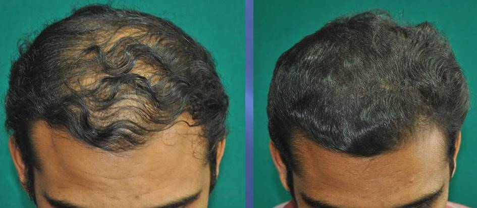 Medicines for hair loss in men